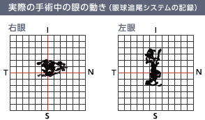 実際の手術中の眼の動き（眼球追尾システムの記録）