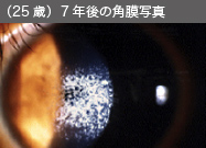 （25歳）7年後の角膜写真