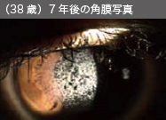 （38歳）7年後の角膜写真