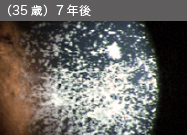 （35歳）7年後の角膜写真