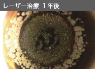 レーザー治療 1年後