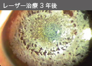レーザー治療 3年後