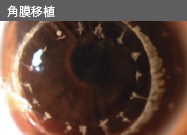 角膜移植