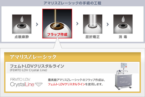 アマリスZレーシックの手術の工程・フラップ作成レーザー技術