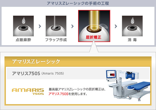 アマリスZレーシックの手術の工程・屈折矯正レーザー技術